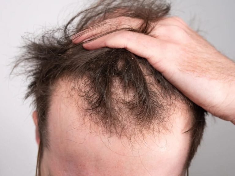 The Relationship Between Testosterone and Hair Loss