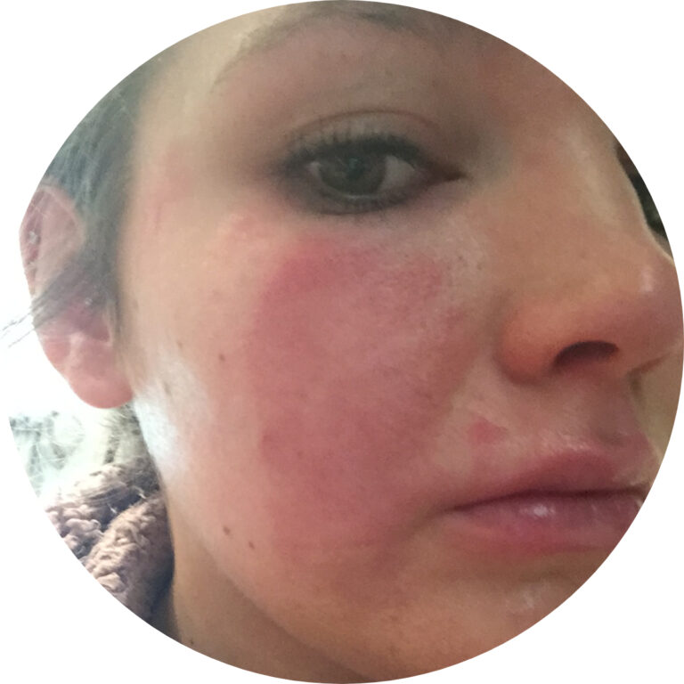 Lorisian food intolerance