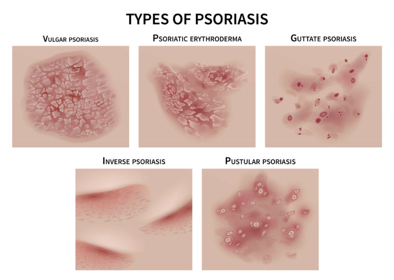 inverse psoriasis diet Svájci pikkelysömör krém