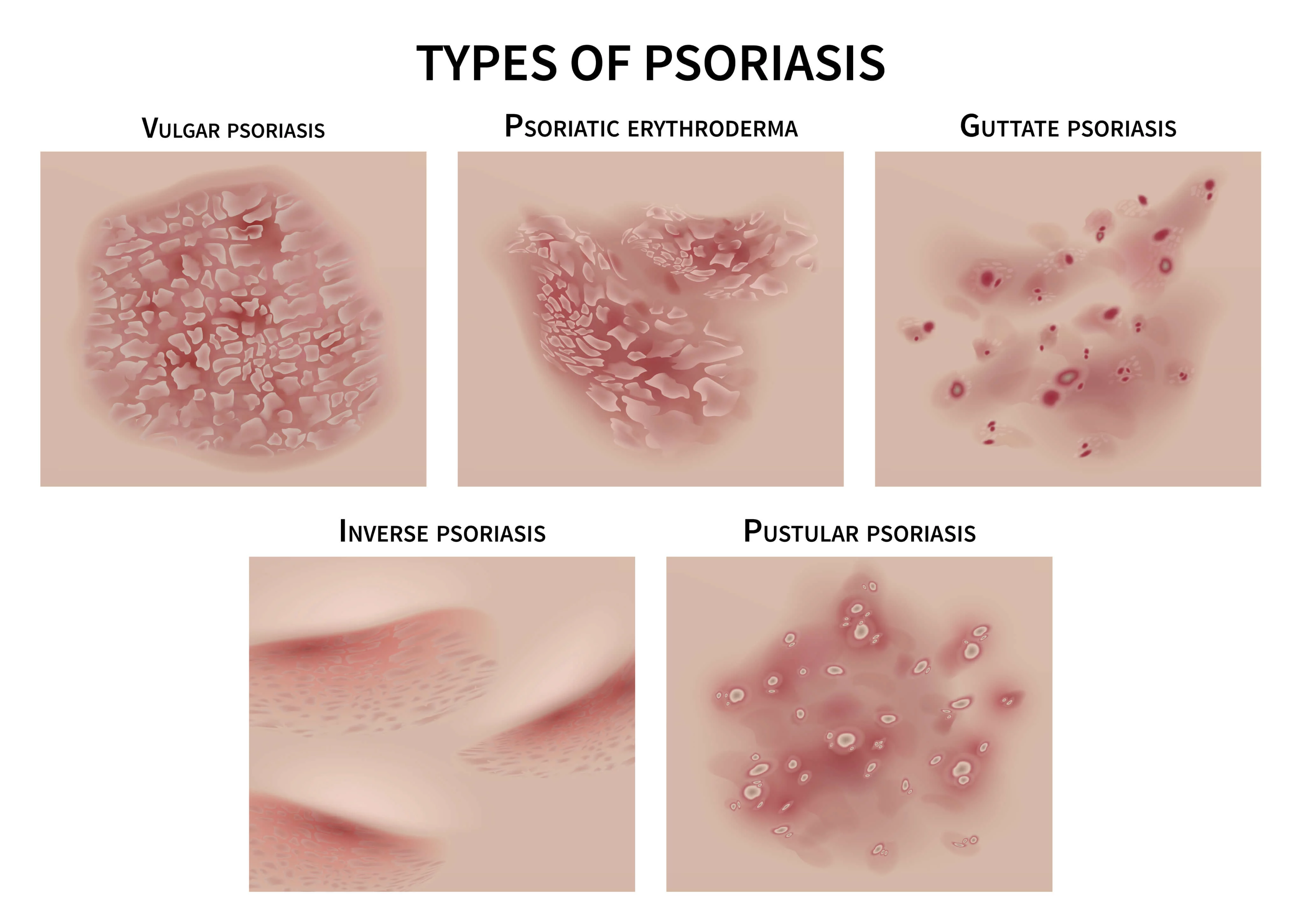psoriasis diagnosis blood test