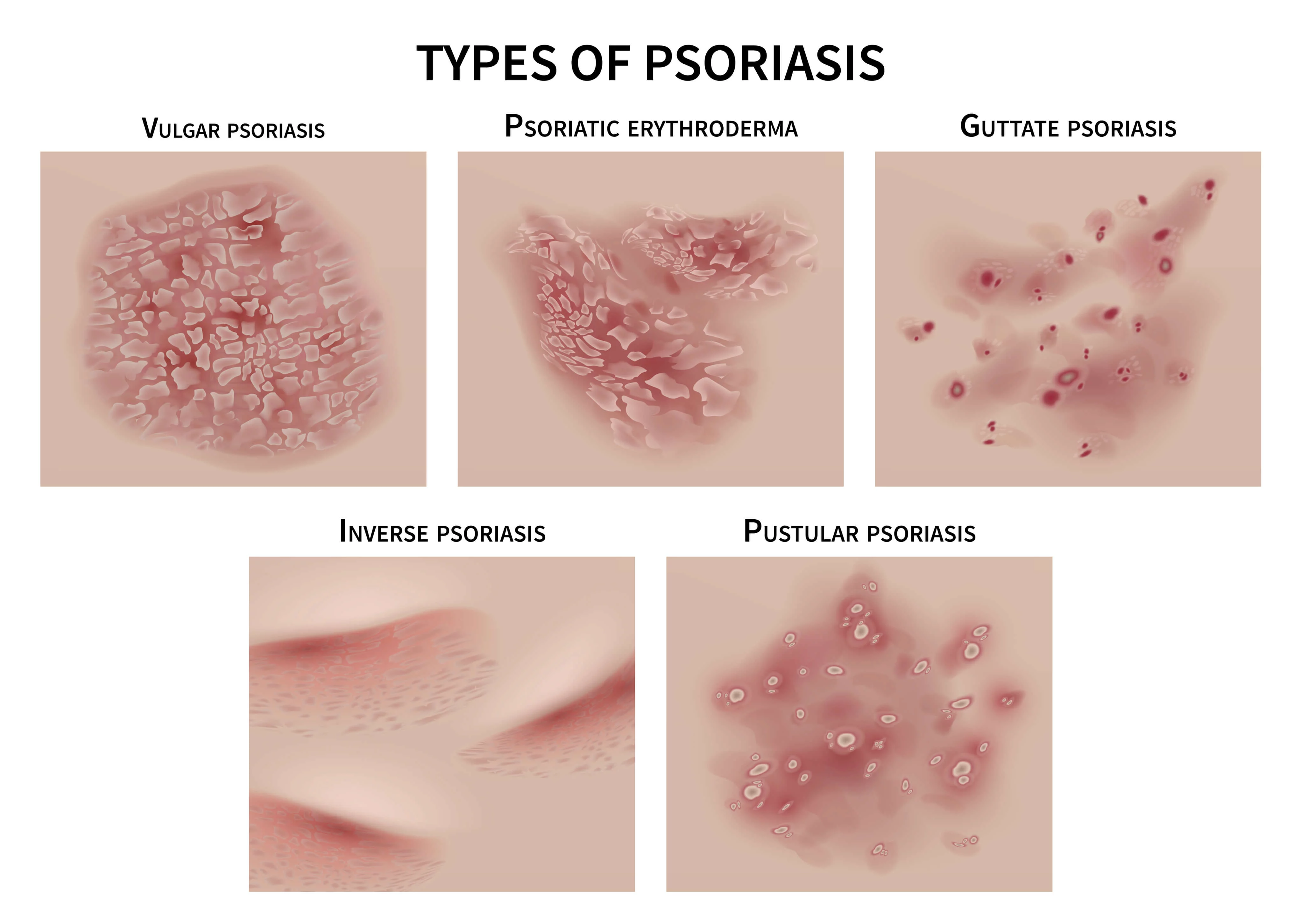 Nátrium-tioszulfát-tisztító a test a psoriasis