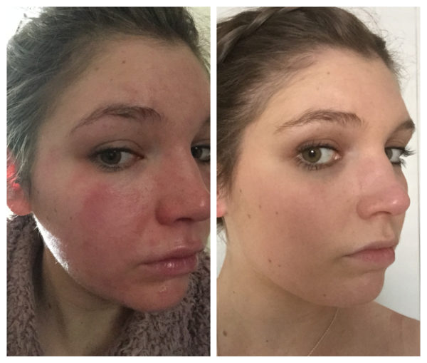 April Ball YorkTest Urticaria