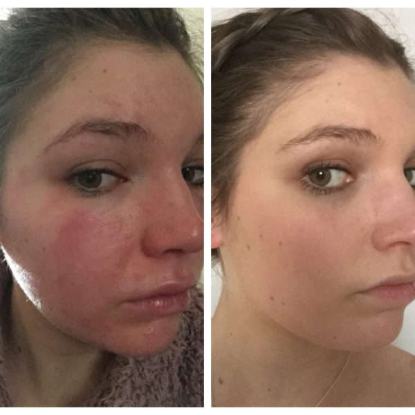 April Ball YorkTest Urticaria