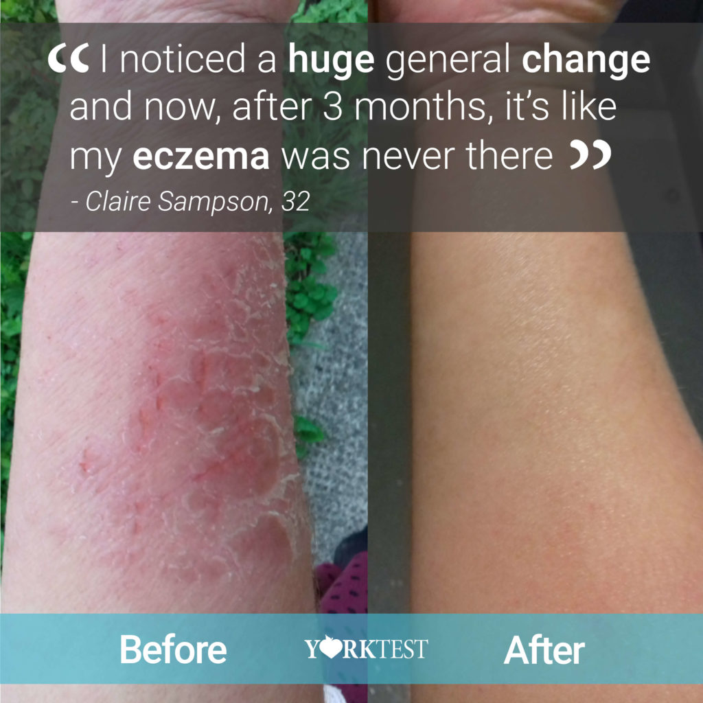 Eczema testimonial before and after picture of a clients' lower arm