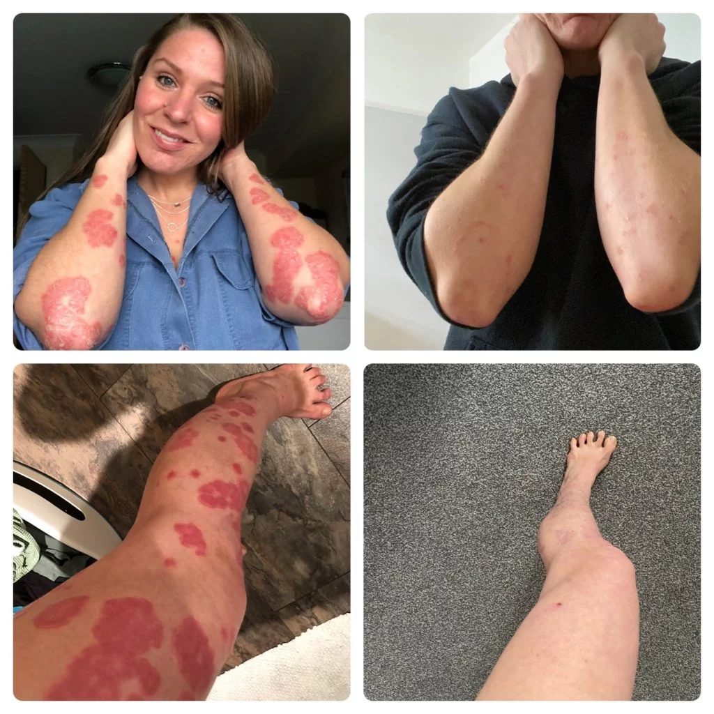 A before and after sequence of pictures featuring a young woman in a blue top, showing her psoriasis on her arms and legs before removing her trigger ingredients and after removing her trigger ingredients.